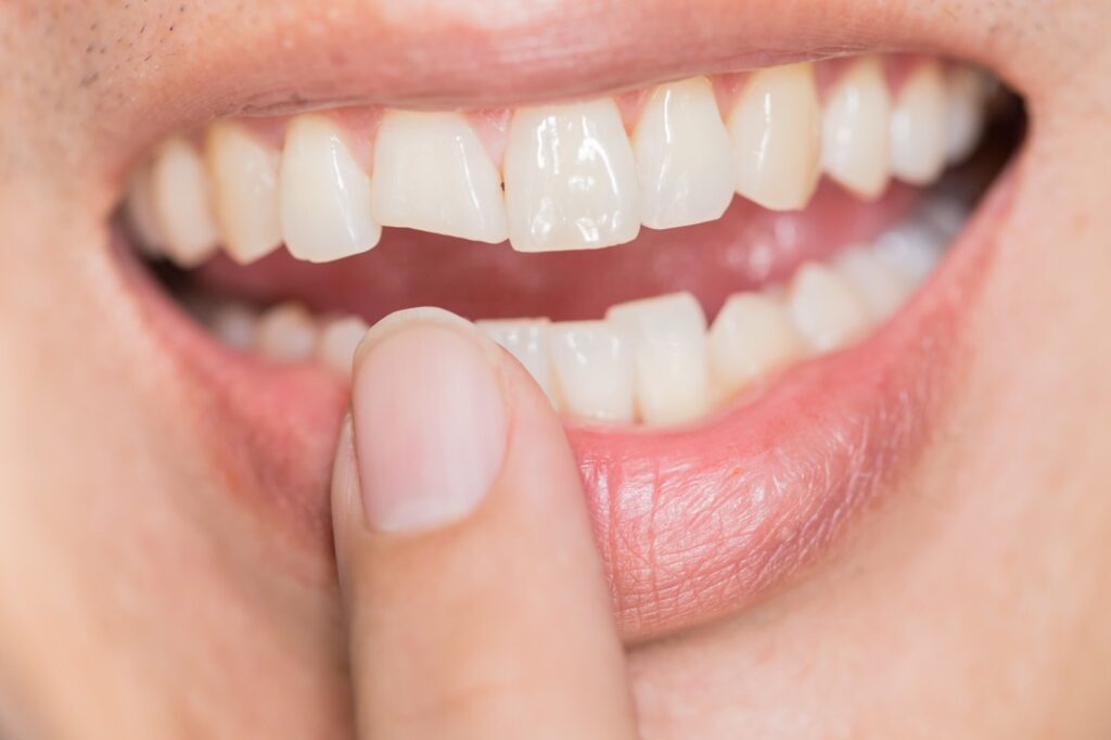 The Importance of Prompt Treatment for Chipped Teeth: What Happens if You Delay in Rancho Cucamonga, CA