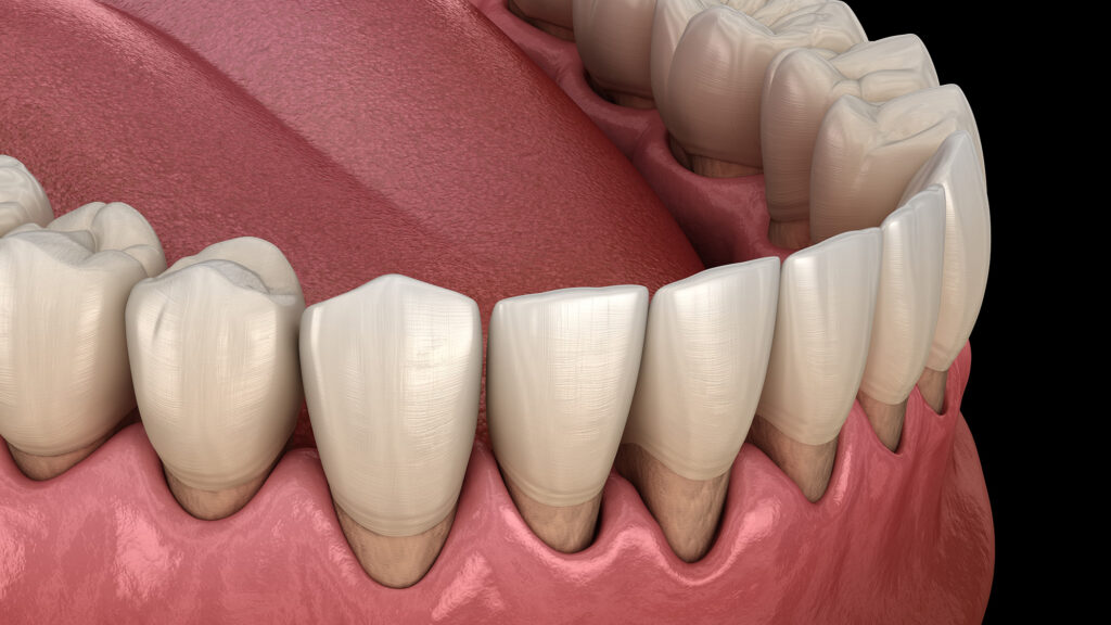 Gum Recession: Causes and Benefits