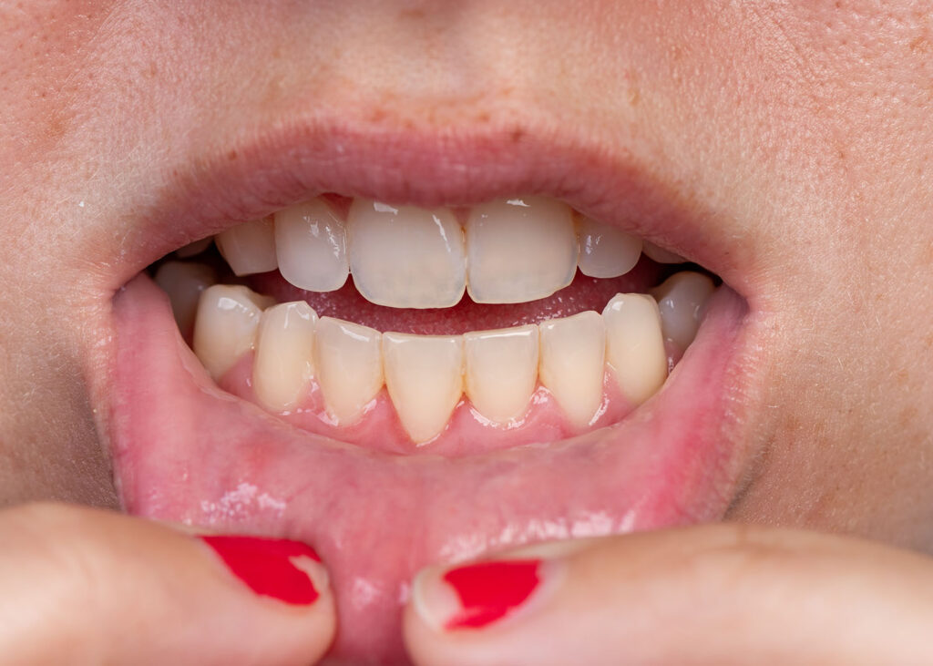 Gum Recession: Recognizing the Signs and Seeking Solutions